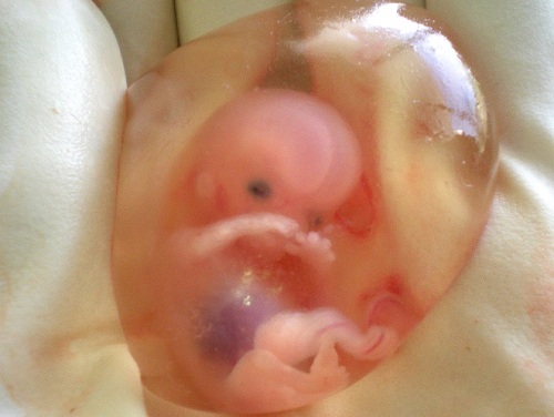 ABORTION tiny fetus