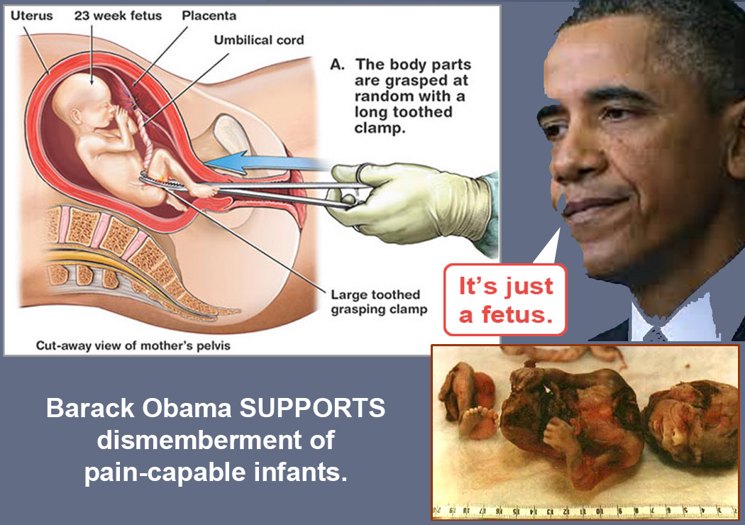 obama-supports-dismemberment-abortion.jpg
